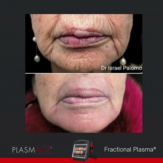 Excellent facial rejuvenation treatment with plasmage®