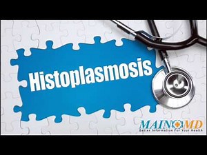 Histoplasmosis ¦ Treatment and Symptoms
