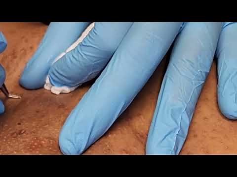 Ingrown Hair Extraction Removal - Episode 67