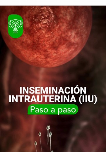 ✨ La inseminación intrauterina (IIU) puede acercarte al sueño de ser mamá 💙 Aquí te explicamos paso a paso cómo funciona, desde la preparación hasta la inseminación. 💡Este tratamiento es menos invasivo y puede ser una gran opción para casos leves de infertilidad cuando las trompas de Falopio funcionan correctamente. Consulte a su médico. #InseminaciónIntrauterina #IIU #ReproducciónAsistida #Infertilidad #Fertilidad #CorneFertilidad #LaboratoriosCorne #PasiónPorTuSalud #IndustriaFarmacéutica #M