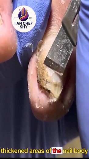 Best Nail Practices for Overgrown Toenails For Better Hygiene #SimpleHealthTricks #HealthyHabits #FootWellnessUSA #NailCareTips | I am Chef Shy