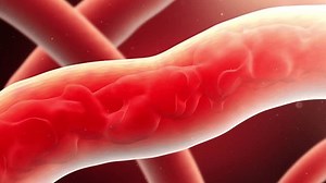 Increased blood viscosity, slower blood flow, hyperlipidemia, hypertension, atherosclerosis, and dyslipidemia symptoms,3d rendering.4K