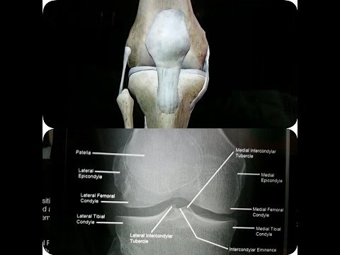 Normal Knee Joint X-Ray with 3D Anatomy