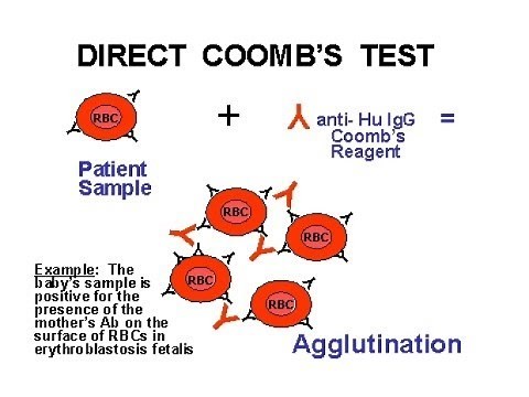 Direct Coomb Test /DCT/Positive/coomb test