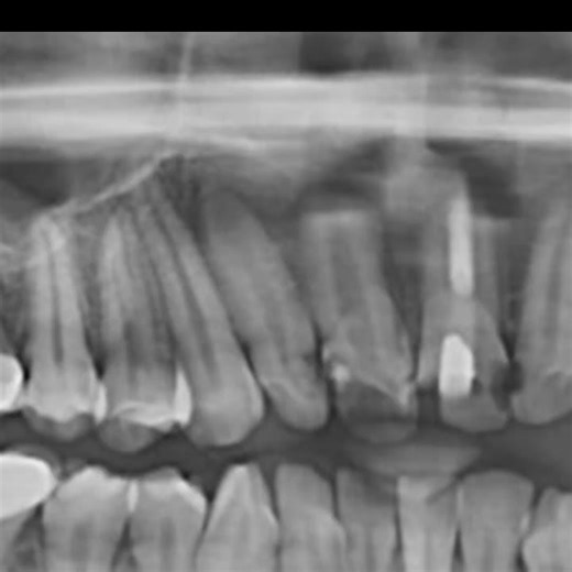Apical barrier with Bioceramic putty#rootcanal #endo #bioceramics #obturation