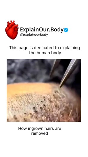 HEALTH | MEDICAL | LIFE | "Ever wondered why ingrown hairs happen? 🧐 In this video, we take a close-up look at how ingrown hairs are professionally removed. Learn... | Instagram