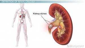 Kidney Stones Symptoms, Causes & Treatments