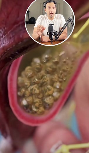 Effective Ayurvedic Recipe for Kidney Stone Relief