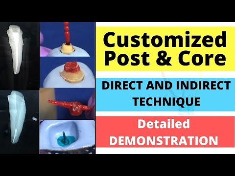 Customized Post and Core Demonstration - Direct and Indirect Technique