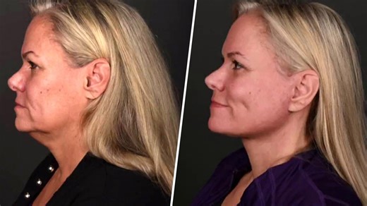 Cosmetic Surgery is Drawing Younger Patients and More Men