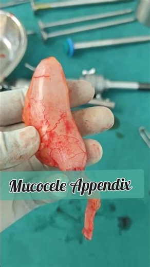 appendix#mucocele appendix#surgery#appendicitis#appendicectomy