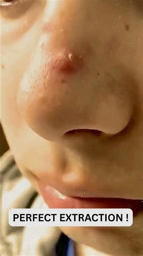 Deep Blackheads, Milia & Whitehead Removal pimple popping New| Big Cystic Acne Extraction #1165 2026