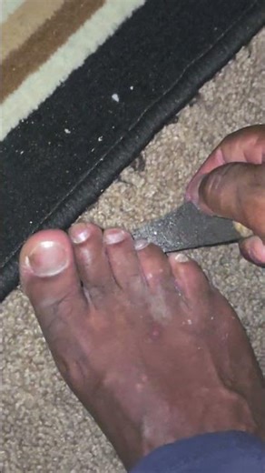 the only way to properly scratch athlete's foot.