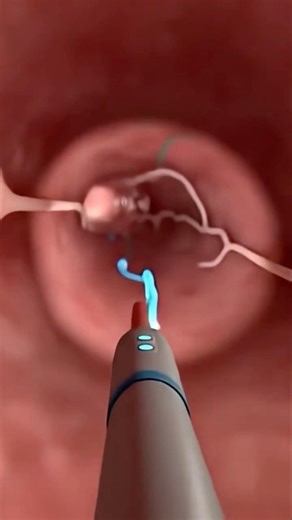3D Animation of Sigmoid Colonoscopy Explained #shotrs