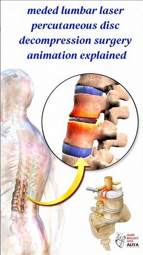meded lumbar laser percutaneous disc decompression surgery animation explained #shorts