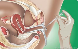 Intrauterine Insemination (IUI) vs IVF