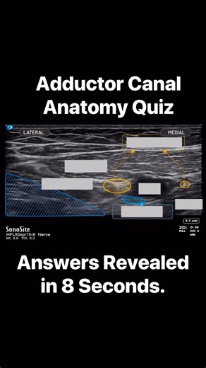 PNBschool - Anesthesia/Peripheral Nerve Blocks on Instagram: "The Adductor Canal Block. This technique changed total knee replacement surgery and is still helping to get patients out of the hospital faster. Pretty good analgesia with no motor block allows for early and consistent ambulation. This is how I learn. Memorize and review often especially when it comes to ultrasound anatomy. I have a tendency to place everything into short term memory (or I’m not that bright). Either way I usually rein