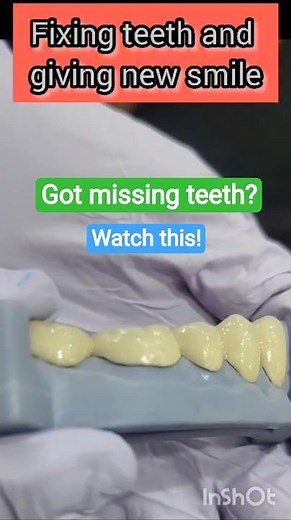 Missing Teeth Solution: Dental Cap Explained!