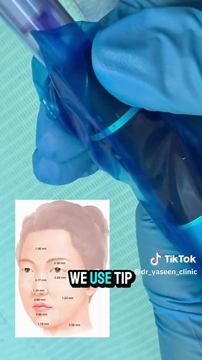 Dermapen Treatment: Step-by-Step Guide by Resident Doctor