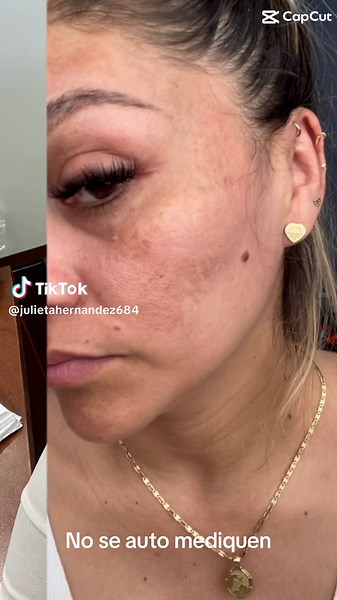 Tratamiento Efectivo para el Melasma: Triluma