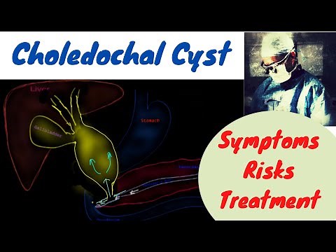 Choledocal Cyst; Symptoms, Classification, Risks, Treatment
