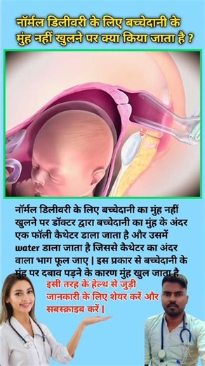What is done if the cervix does not open for normal delivery? Normal Delivery tips #viral