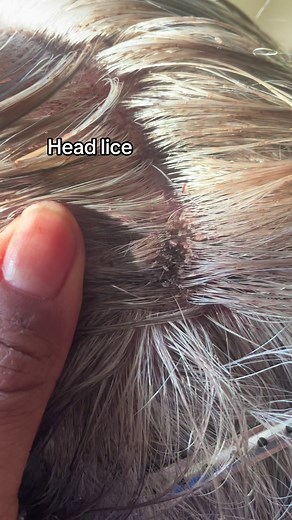 Effective Lice Removal Techniques for Kids