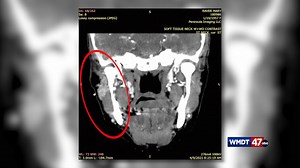 How a Cancer misdiagnosis sparked the largest Malpractice settlement in Wicomico County History - 47abc