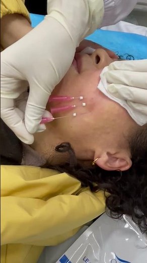 PDO thread lift with PDO screw threads