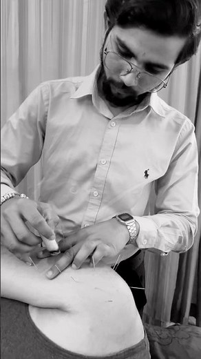 Moxa Dry Needling Therapy for Muscle Stiffness & Trigger Points