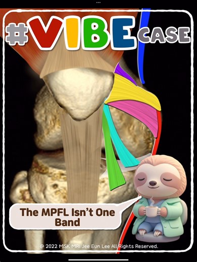 MSKMRI on Instagram: "“📌 MPFL: It’s Not One Ligament.” “The two components every radiologist must recognize.” MPFL Anatomy — Ultra-Short Clinical Guide 1) MPFL = TWO Components Not one band, but a two-part complex: Transverse component • From the medial femoral epicondyle → adductor tubercle Oblique decussation component • From the superficial MCL 2) Common Insertion Both components merge and insert onto the medial patella (plus deep fibers of the vastus medialis). 3) Key MRI Tips The transvers