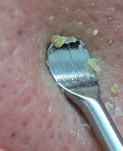 Nose Sebum Boom !! #pimplepopping #sebum #acne #pimple
