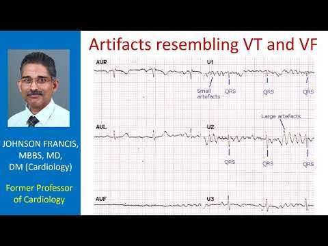 Artifacts resembling VT and VF