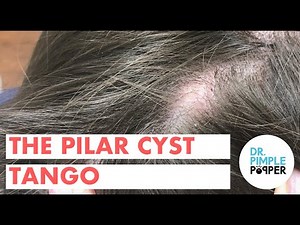 The Pilar Cyst Tango