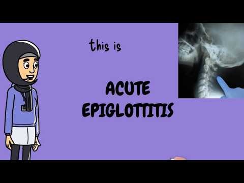 Acute Epiglottitis - Quick and Easiet explanation ever , signs and symptoms , lab finding ,treatment