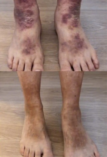 Effective Eczema Relief with Eczema Powder and TCM Herbs