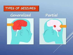 Seizure disorders - URIS