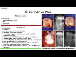 Management of OPEN APEX Cases Webinar for Endohaveli