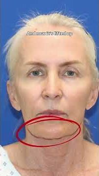 62-Year-Old’s Second Facelift Recovery