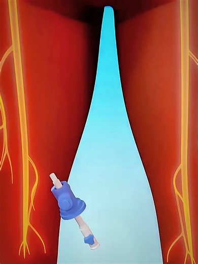 How a Milli Spinner Works (Medical Tool Explained) #millispinner #medicaltechnology #strokesurvivor #medicalanimation