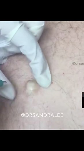 Cyst extraction with punching method continues #acneshot #cyst #cystpopping Follow for more videos