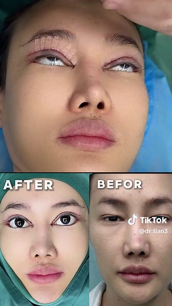 #眼瞼下垂＃腫眼泡＃納米無痕雙眼皮 #鬆弛下垂#全切雙眼皮 #全切開二重術 #縫雙眼皮 #微創雙眼皮 #雙眼皮 #切眼袋
