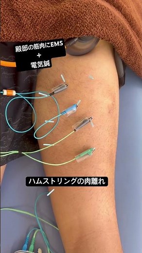 EMS + electroacupuncture on the glutes for hamstring strain (recovery phase)