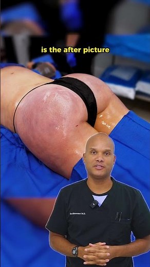 The Magic of BBL Explained by Dr. Brewster