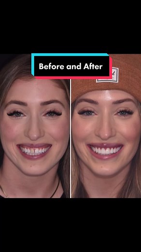 Smile Makeover Transformation with Veneers Journey