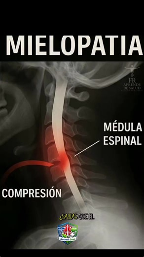 ⚠️🧠 La mielopatía ocurre cuando la médula espinal se comprime y altera los movimientos 😨 #Mielopatia #Columna #Anatomia