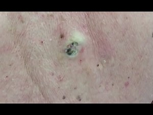 Two HUGE Dilated Pores of Winer!!!