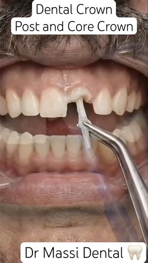 Post & Core Crown , Fiberoptic post front tooth