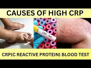 CAUSES OF HIGH CRP(C REACTIVE PROTEIN).CRP BLOOD TEST.CRP 10MG/L,25MG/L WHY AND HOW TO REDUCE CRP?