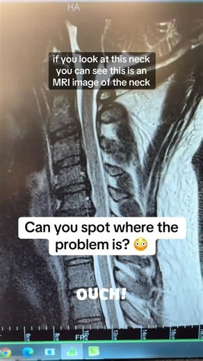 Steven J Cyr on Instagram: "Can you spot where the problem is? #doctorreacts #acdf #spinesurgery #doctorlife #necksurgery…. ➡️SASpine.com (offices in Houston and San Antonio)"